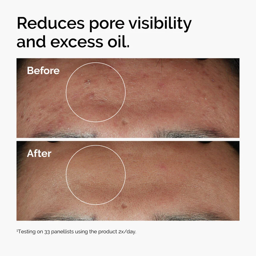 The Ordinary Niacinamide 10% + Zinc 1% - Image 4